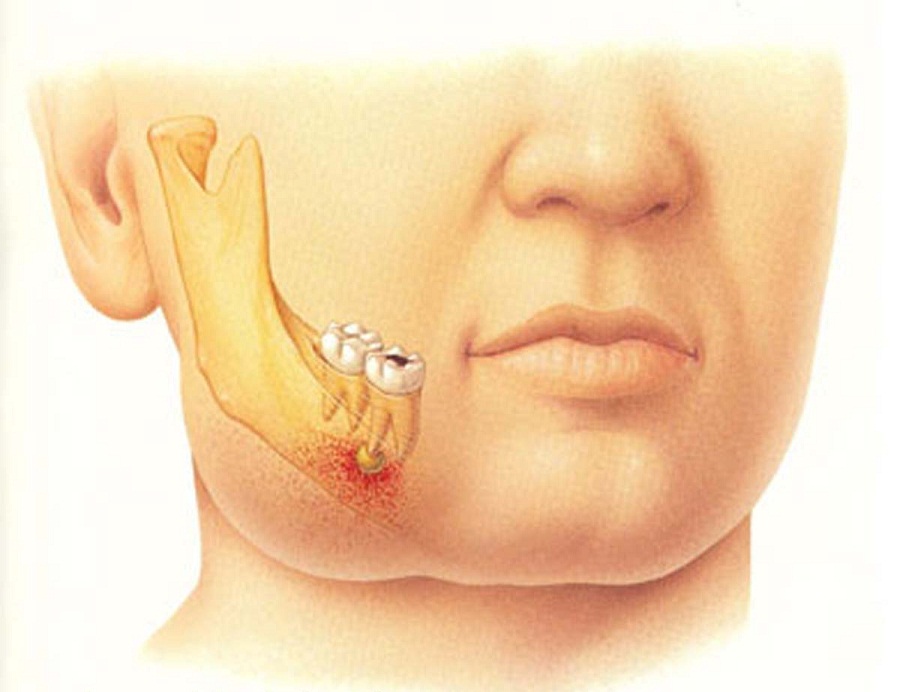 Penyebab Gusi Bengkak Dan Cara Mengobati Gusi Bengkak Yang Susah Sembuh