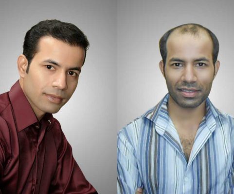 Fut Single Harvesting Versus Fue How Much Does Hair Transplant