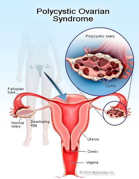 Polycystic Ovary Sex 36