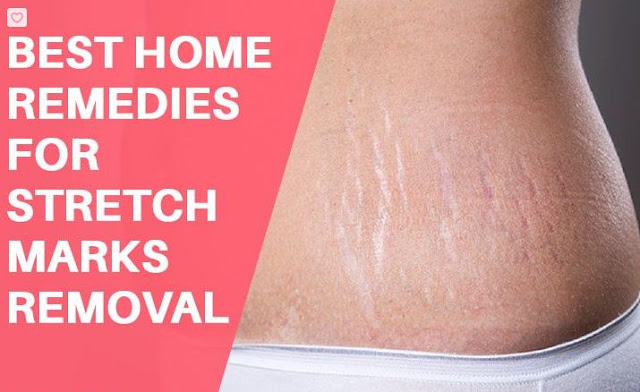 Best Home Remedies for Stretch Marks Removal Naturally