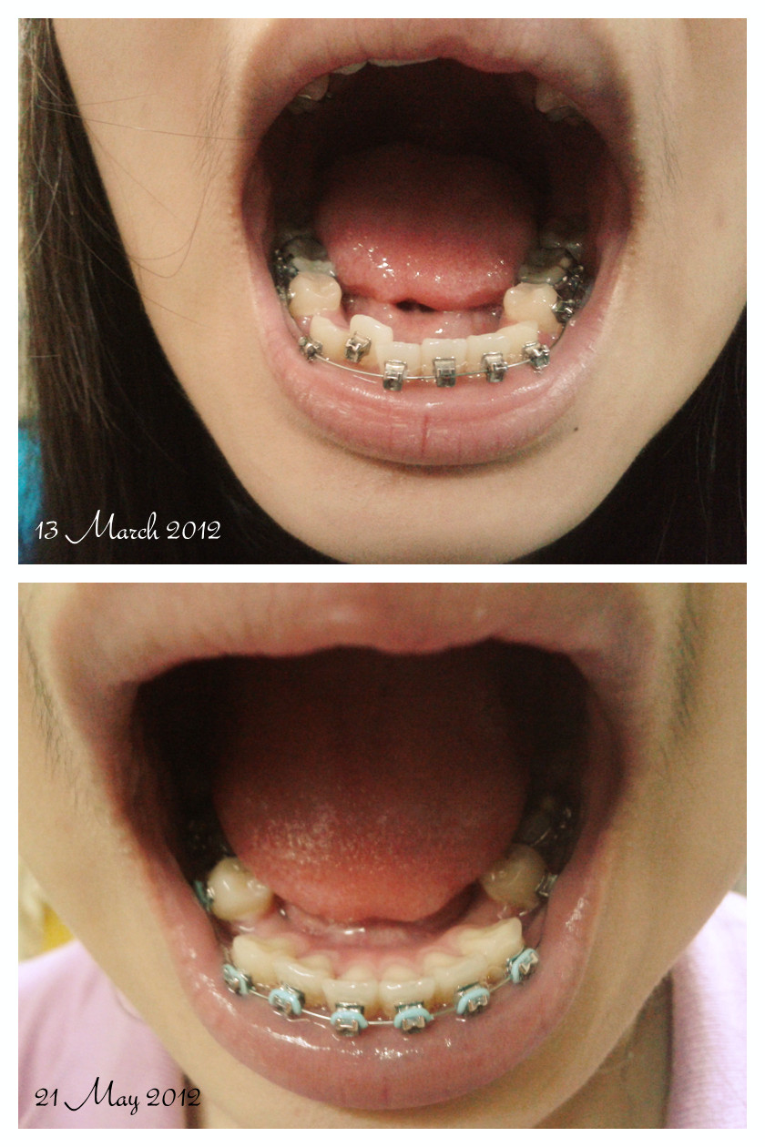 Live. Laugh. Love After 70 days of putting on braces