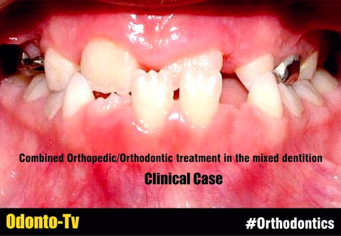 CLINICAL CASE: Combined Orthopedic/Orthodontic treatment in the mixed dentition