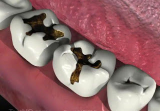 hàn răng sâu có đau không  ?