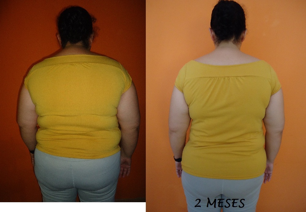 Diário da minha cirurgia bariátrica: Fotos antes e depois - 60 dias