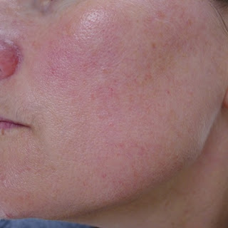 Rosacea, rosacea, bother this rosacea.: Still battling the demodex ...