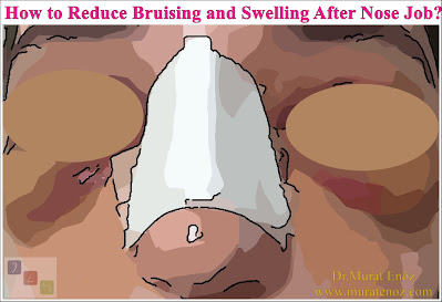Bruising And Swelling After Nose Job - Rhinoplasty Recovery Information - How To Perform A Cold Spplication After Nasal Aesthetic Operation? - Nose Aesthetic Operation And Season Selection In Istanbul - Nose Re-Shaping In İstanbul - Nose Job Operation In İstanbul - Rhinoplasty In Istanbul - Natural Nasal Aesthetic Operation - Aesthetic Nose Surgery - A Herbal Product Obtained From Arnica Montana Flower: Arnica Gel / Arnica Cream - Drugs That Increase Bleeding Risk When Used Before Nose Aesthetic Surgery - What Are The Benefits Of Massage And Massage After Nose Aesthetic Surgery? - Summary Of What To Do To Reduce Edema And Bruising After Nasal Aesthetic Operation! - Hilotherapy System (Hilotherm): Ideal Cold Application Method After Nose Aesthetics - Nose Aesthetic Operation And Season Selection In Istanbul - What Can Be Done In Order To Reduce Bruising And Swelling Before Nose Job Operation? - What Are The Situations That Can Increase Bruising And Swelling After Rhinoplasty Operation? - Cold Sterilized Serum And Ice Application On The Nose During Rhinoplasty Operation - Why Does Edema And Bruising Are Seen After Nose Job Surgery?