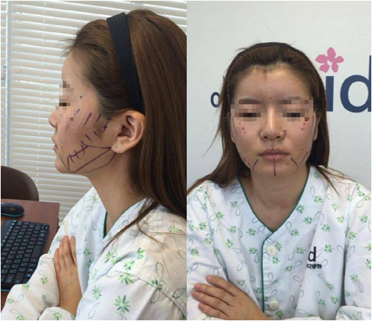 รีวิวศัลยกรรมเกาหลี : ศัลยกรรมวีไลน์ โหนแก้ม แก้จมูกที่ โรงพยาบาลไอดี! รีวิวศัลยกรรมเกาหลี : ศัลยกรรมวีไลน์ โหนแก้ม แก้จมูกที่ โรงพยาบาลไอดี!