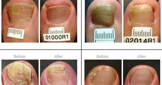 Does Vicks VapoRub cure toenails fungus? - healthymasters
