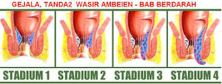 Obat Salep Wasir Untuk Ibu Hamil