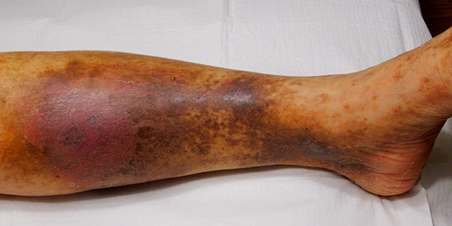 Jangan Sepelekan Kaki, Bisa Jadi Penyakit Ini Bisa Muncul Lewat Perubahan Pada Kaki Jangan Sepelekan Kaki, Bisa Jadi Penyakit Ini Bisa Muncul Lewat Perubahan Pada Kaki