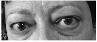 oftalmopatia graves