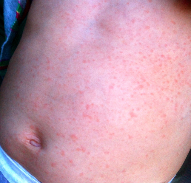 roseola rash pictures in children