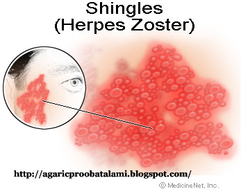 Cara Mengobati Penyakit Herpes Atau Cacar Air Secara Alami ~ Obat