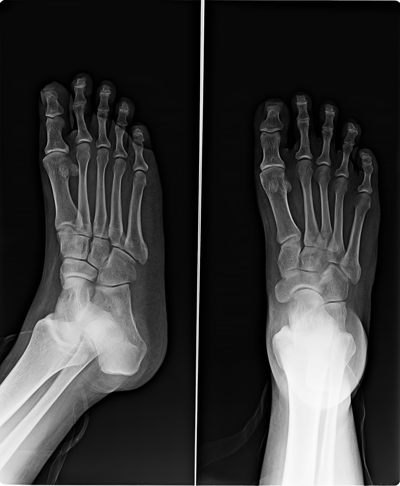 Asthacare Spandan Imaging Centre 07 10 17 Vinodbhai Darbar M 45y Rt Foot Ap Oblique