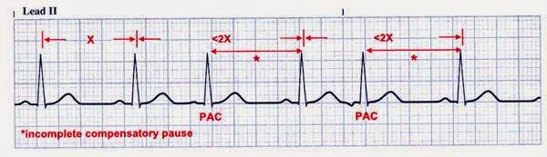 Premature Atrial Contraction / Atrial Ekstrasistol | INA - ECG