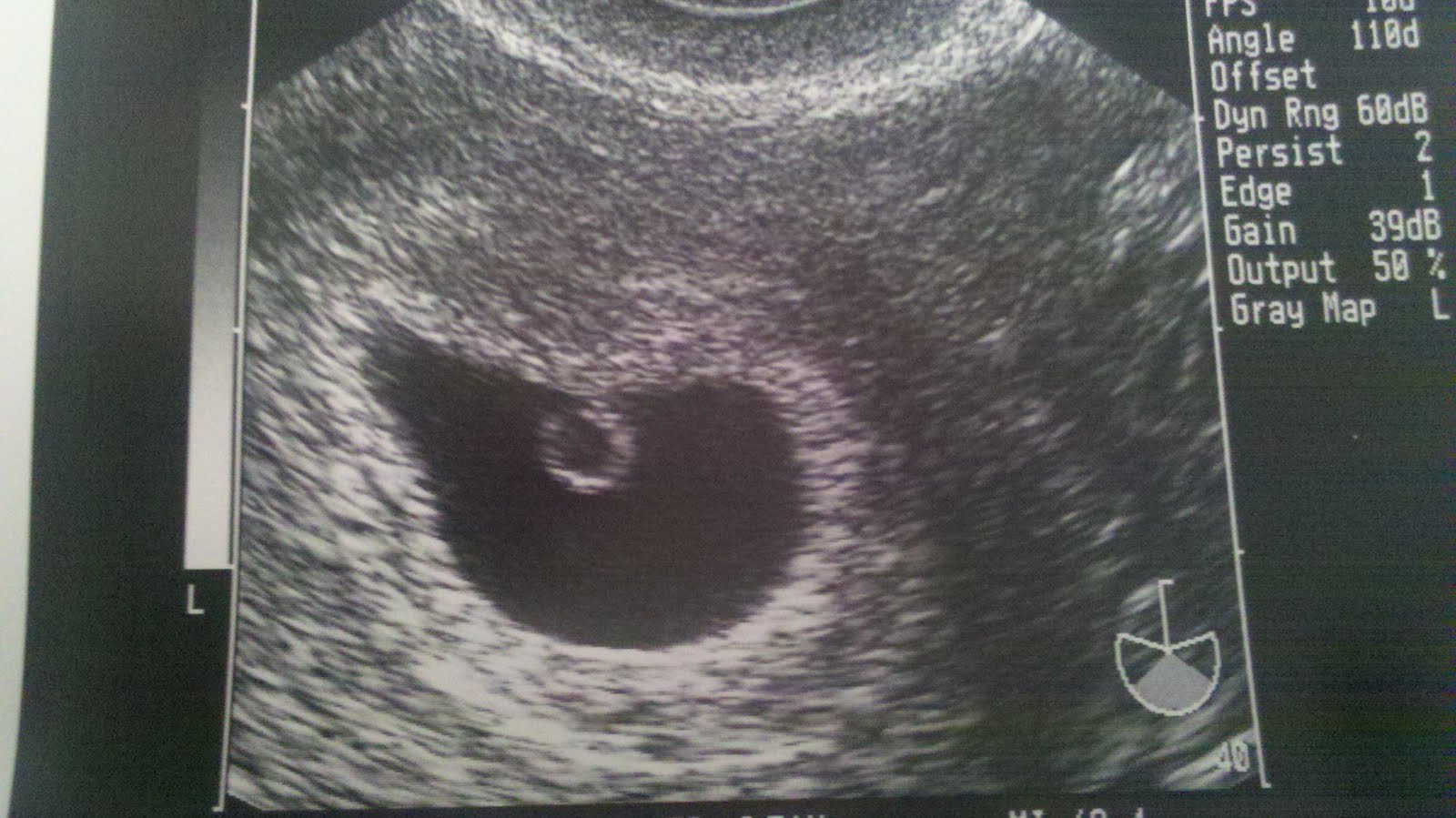 6 недель изменения. 5 Weeks Ultrasound.