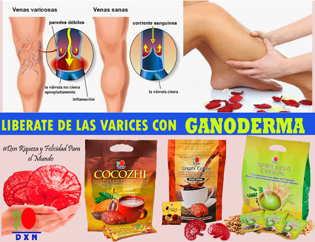 Resultado de imagen para VÃ¡rices - Causas y Tratamiento con Ganoderma DXN