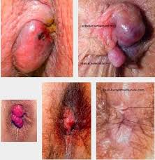 Foto Selain Ambeven? Obat Herbal Manjur Ambeyen Apa?