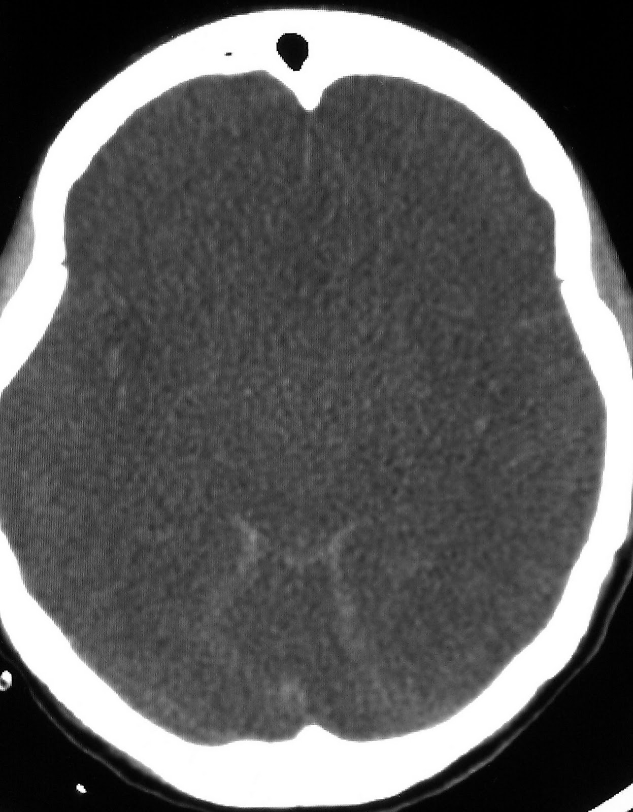 Learning Neuroradiology: Case 94 - Severe Diffuse Hypoxic Brain Injury