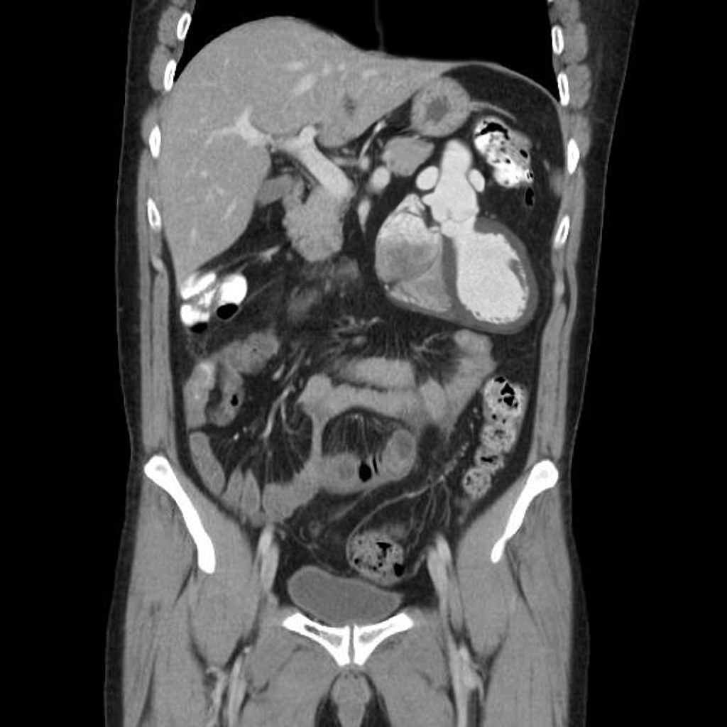 Chest Medicine Made EasyDr Deepu Tin Man Syndromes or Ectopia cordis