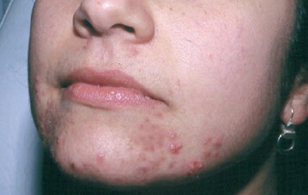 Pimples around Mouth - Causes and How to Get Rid