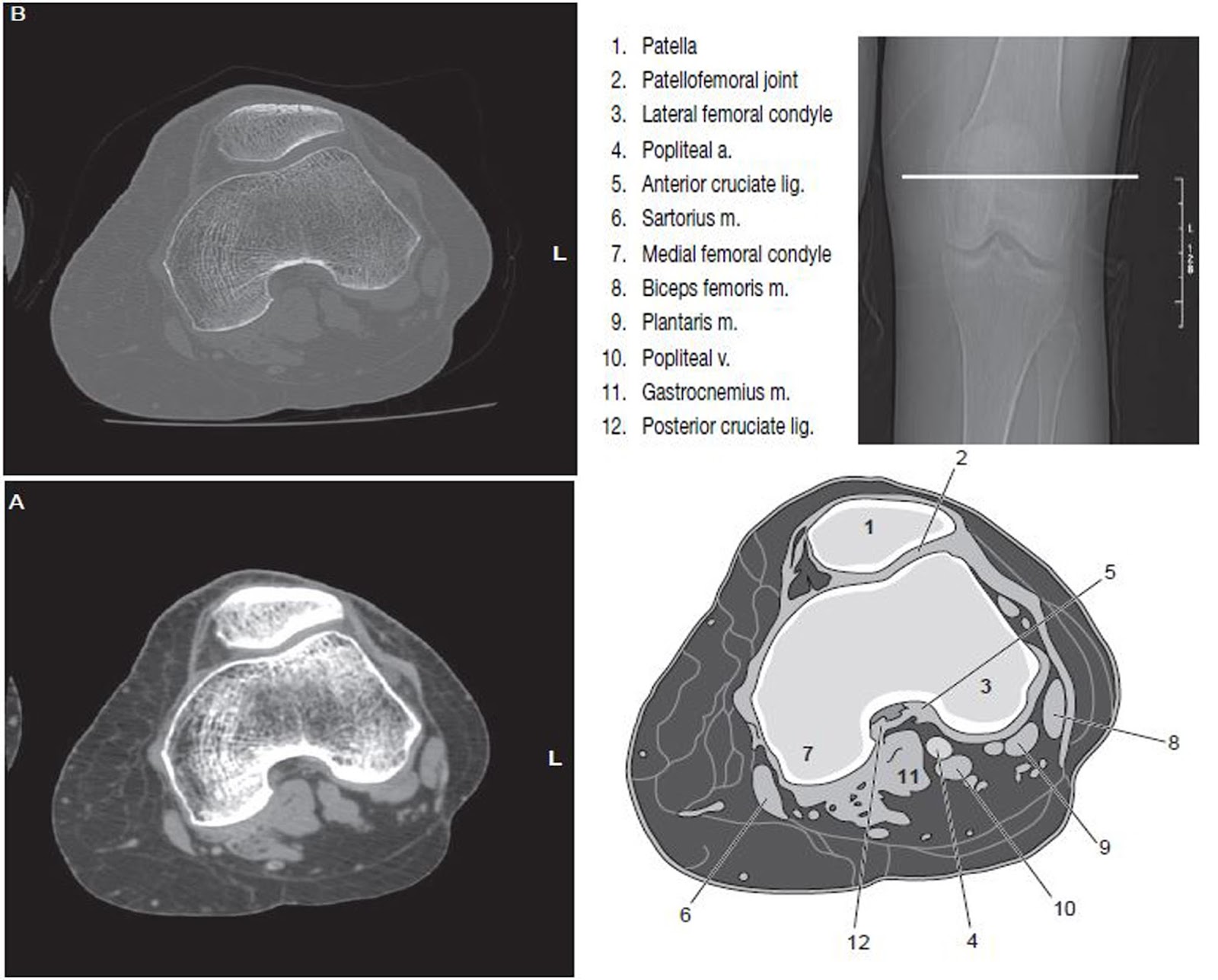 Left Knee Ct Scan Images With Label Radtechonduty