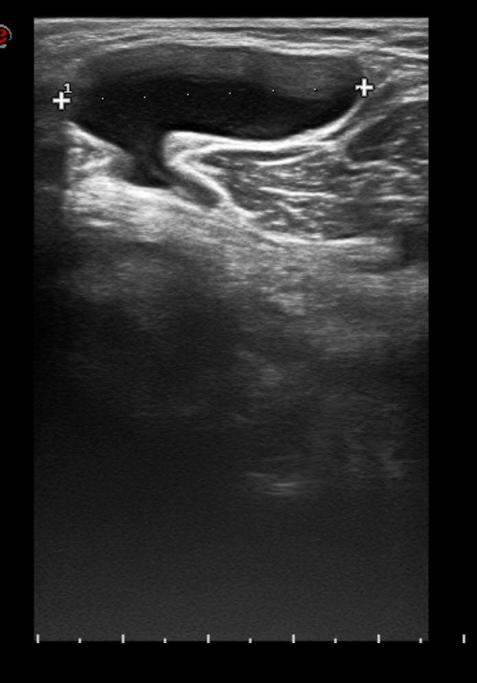 Radiology Station Bakers Cyst