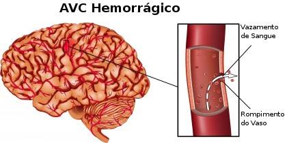 Acidente Vascular Cerebral Hemorrágico O que é? - VIDA DE BOMBEIRO