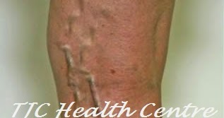 comentariile puternice de tratament pentru picioarele varicoase gel nano de la varicoză pe picioare