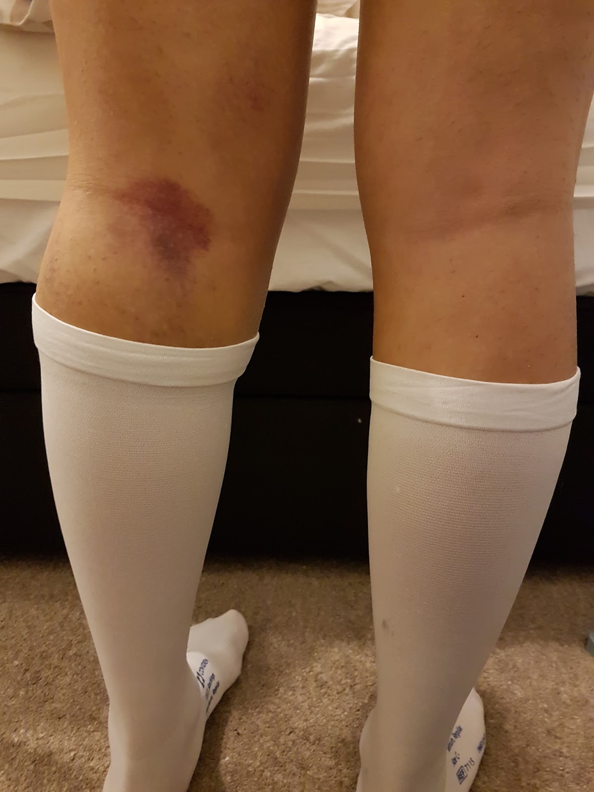 does your leg get shorter after hip replacement