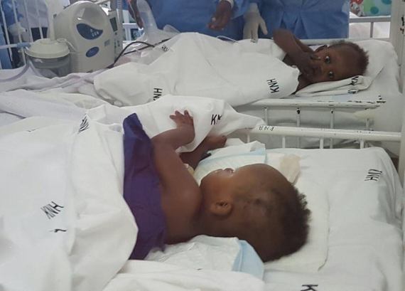 Photos Conjoined Twins Meet For The First Time After Historic Surgery In Kenya