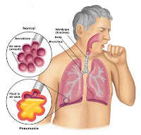penyakit paru-paru, gejala infeksi paru paru