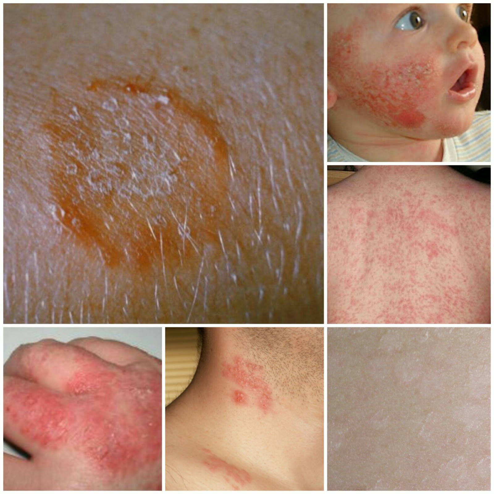 Harvest ministry Bedak Asmak Merawat Penyakit Kulit Ekzema dan Psoriasis - Shad | Beauty