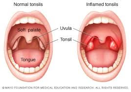 Penyakit Tonsil atau Sakit Tekak dan Rawatan Secara Semulajad