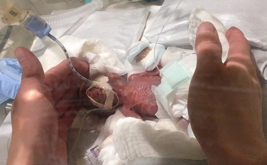 Record nascita del bambino più piccolo del mondo. Record nascita del bambino più piccolo del mondo.