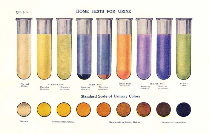 Cairan empedu yang memberi warna pada urine dan feses dihasilkan oleh