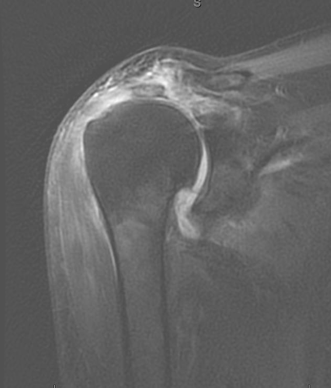 Shoulder and Elbow Surgery Reverse total shoulder arthroplasty for