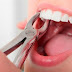 Nhổ răng để niềng có ảnh hưởng gì không? Thông tin tư vấn