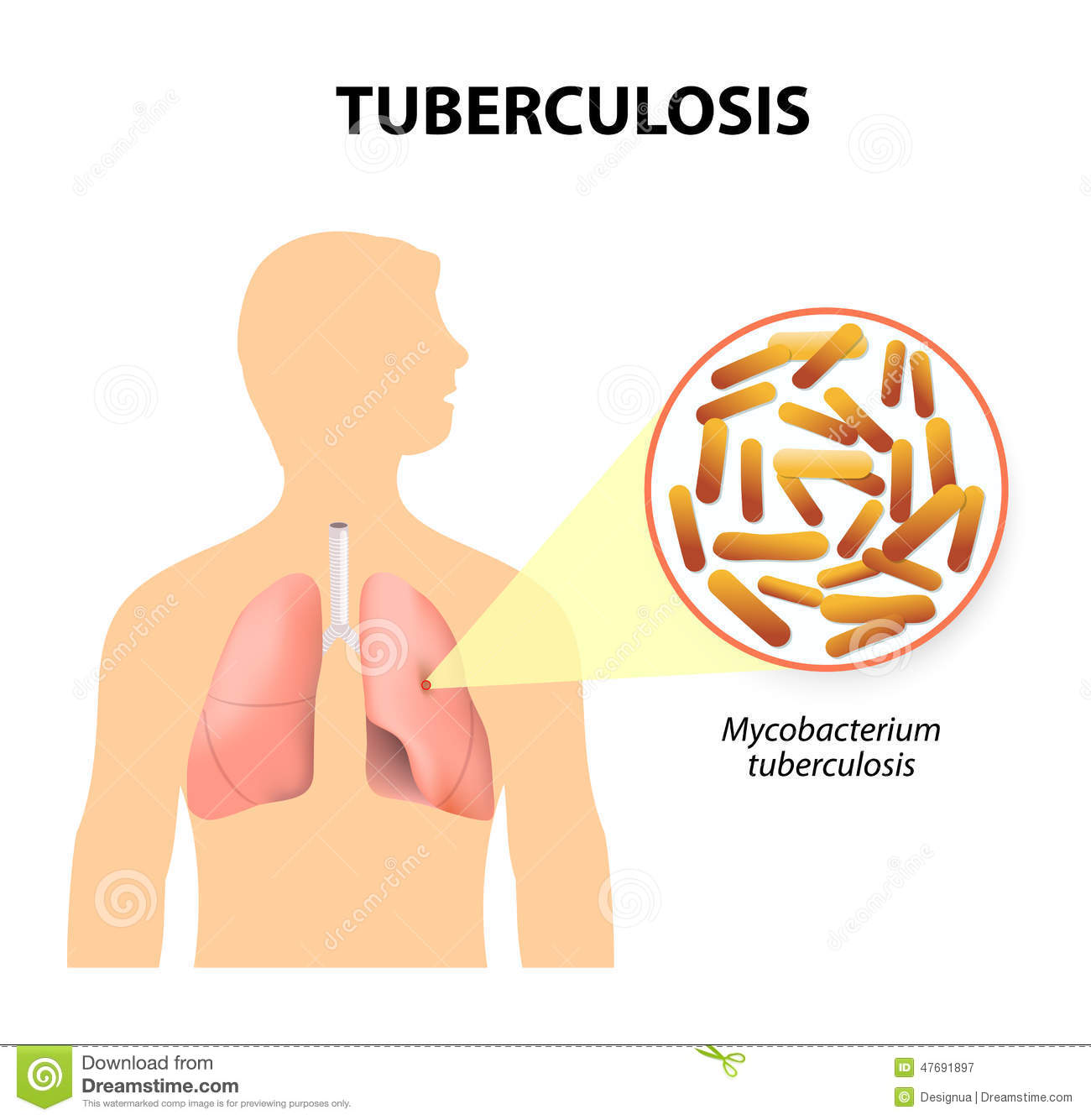 BACTERIOLOG A CLINICA TUBERCULOSIS bacteriolog-a-clinica-tuberculosis
