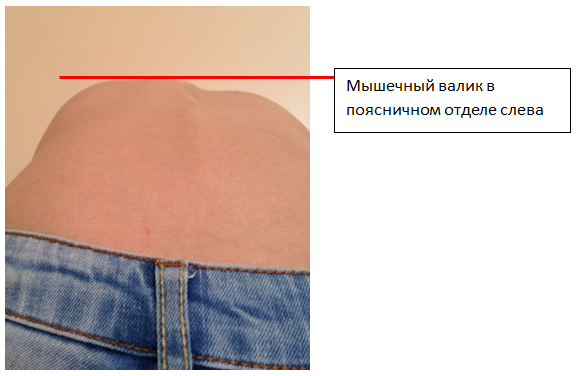 мышечный валик при сколиозе. треугольники талии. правосторонний грудной сколиоз. мышечный валик при сколиозе.