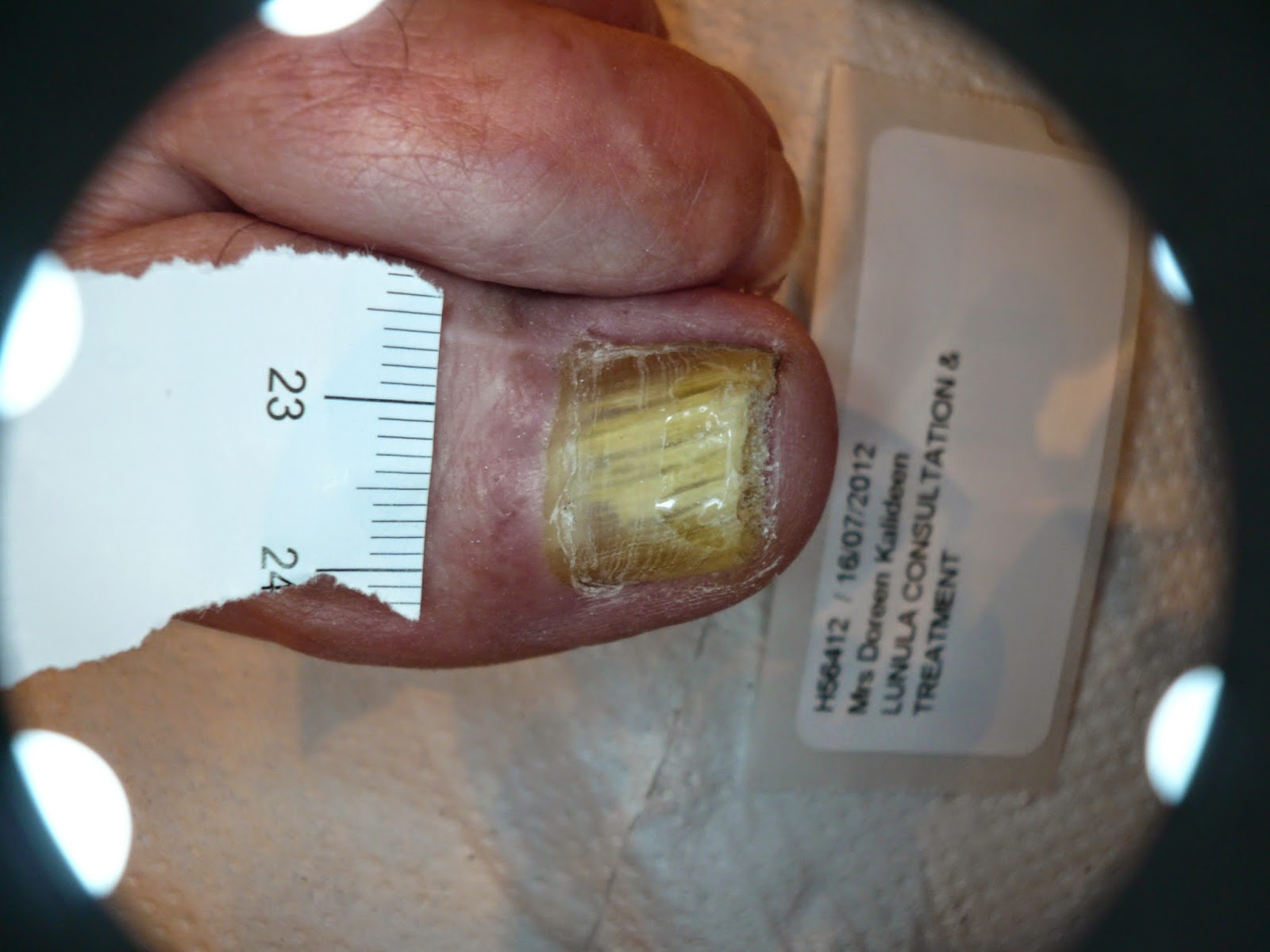 The London Nail Laser Clinic Best Treatment Options to Cure the Fungal