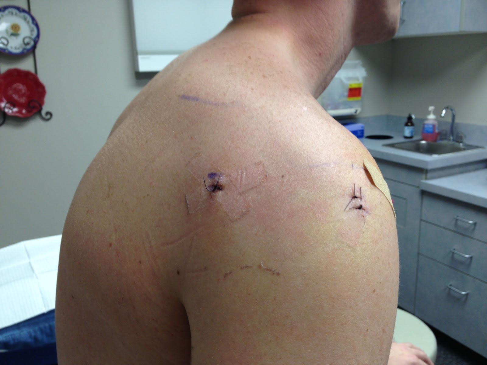 Team Johnson: Nate's Surgery