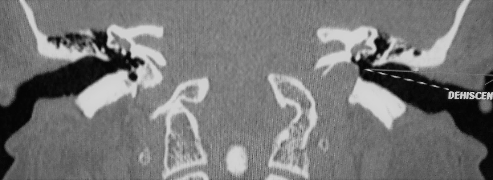 Dehiscent jugular bulb CT Sumer's Radiology Blog