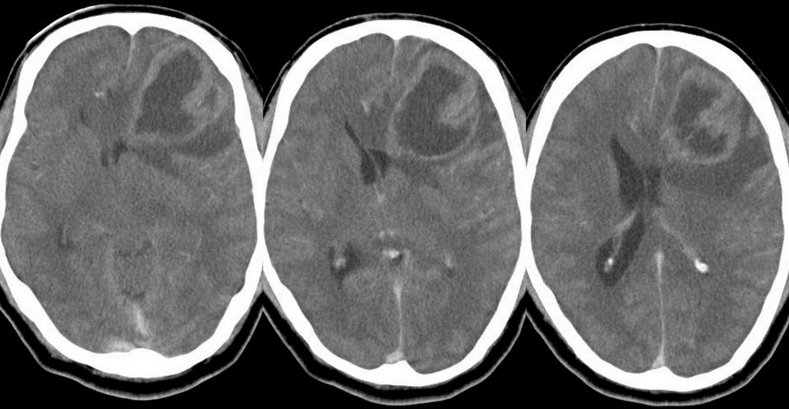 Ayurvedic Treatment for Glioma the Best Solution