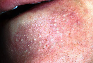 Papules (boutons)