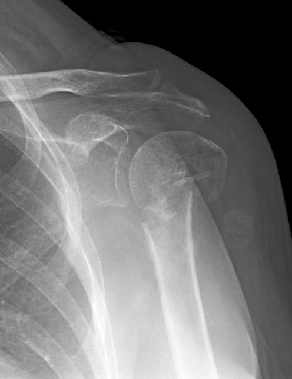 Shoulder and Elbow Surgery Non operative treatment of the fracture of