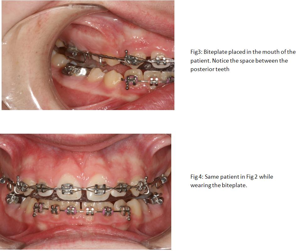 Dental Library Bite Plates