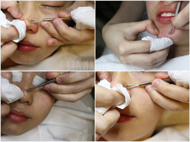 Extractions During Facial 49