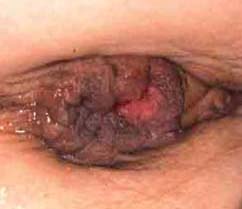 Hard Anal Lump - Small lumps inside anus - Porn Images
