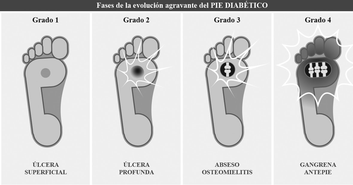 GUSTAVO PAVKA. PODÓLOGO........ Pie del Diabético